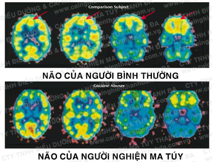 Não của người bình thường vs Não của người nghiện ma túy